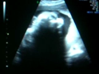 3EME ECHOGRAPHIE (4)