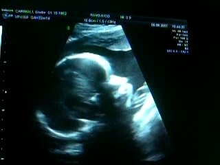 3EME ECHOGRAPHIE (5)