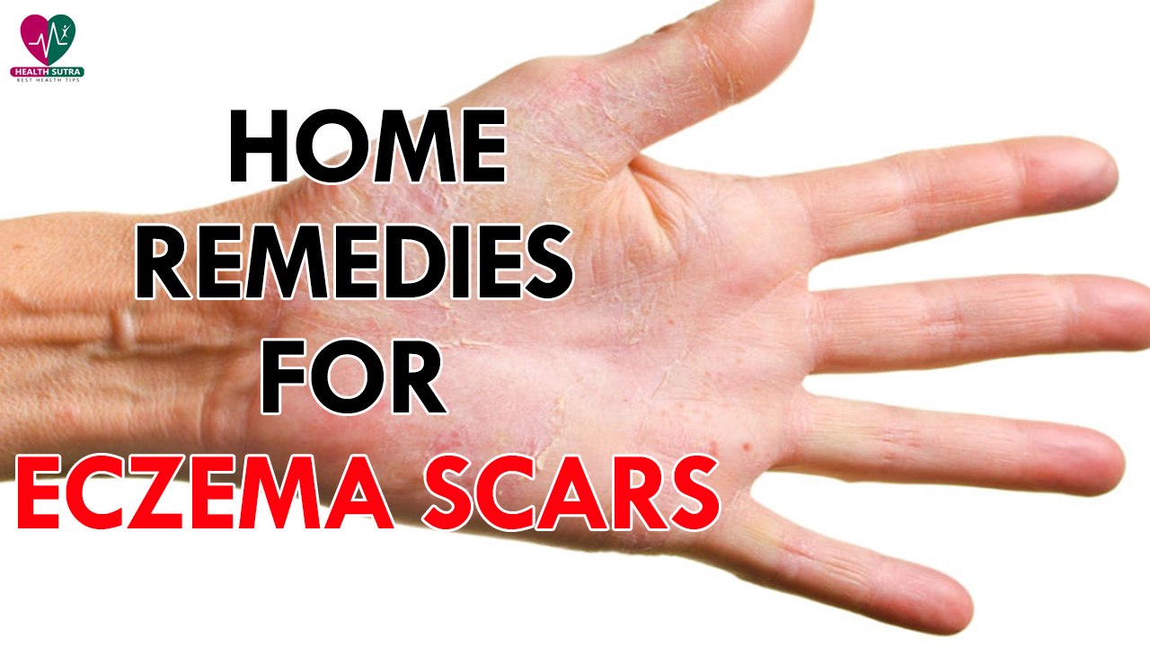 Home Remedies For Eczema Scars - health Sutra