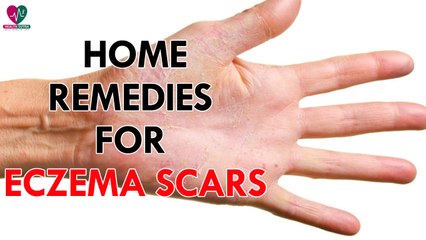 Home Remedies For Eczema Scars - health Sutra