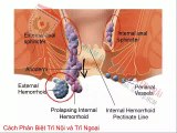 Phân biệt bệnh trĩ nội và trĩ ngoại như thế nào?