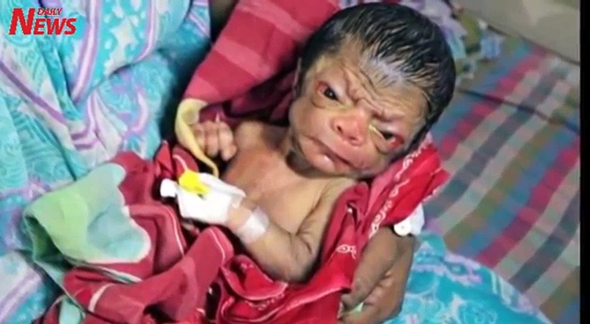 Un Bebe Vient Au Monde Avec L Apparence D Un Vieux De 80 Ans Video Dailymotion