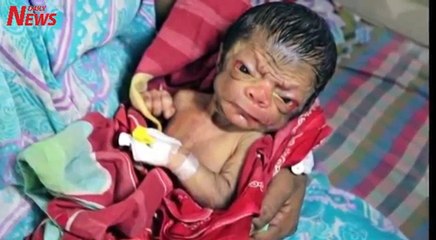 Un bébé vient au monde avec l'apparence d'un vieux de 80 ans