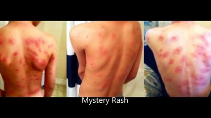 MYSTERIOUS EPIDEMIC in Cali school HUGE “BITES” OFFICIALS have NO IDEA what's Causing them!