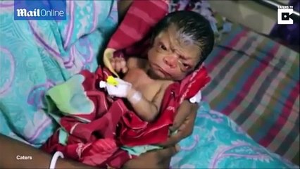 Nace un bebé con cara de anciano y pelos en la espalda