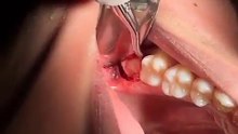 Tooth Extraction P1