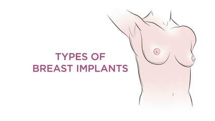Types of Breast Implants