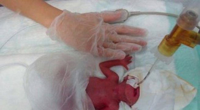 380 Gramlık Azra Bebek Yaşama Tutundu