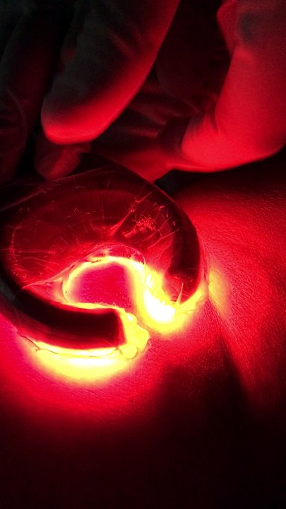 La mousse endoveineuse fibrosante: c'est un complément thérapeutique à la microchirurgie.
