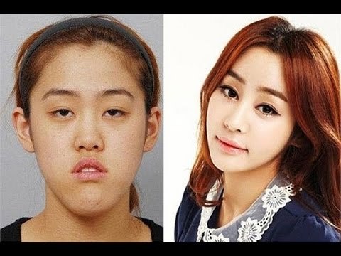 Korean Girls Plastic Surgery- Shocking Before And After Photos-