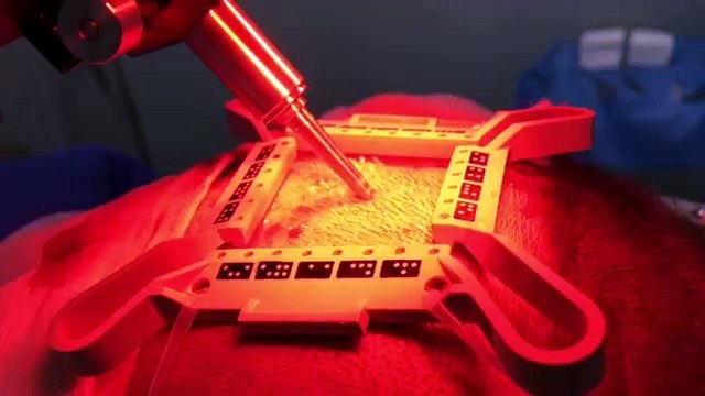 TheClinic-20160915-Artas-prelevement