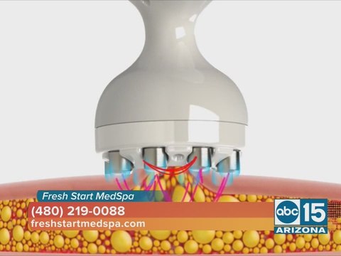 Fresh Start MedSpa: Fusion Contouring combines two non-surgical procedures