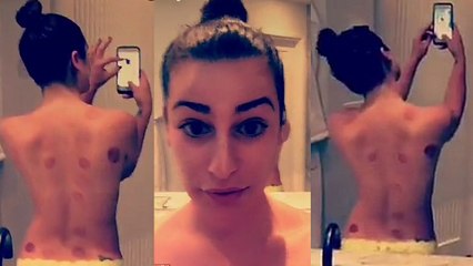 Lea Michele Shows Off  Cupping Marks On Back in Topless Snap