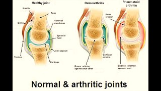 Arthritis - [General Information for Patient Awareness]