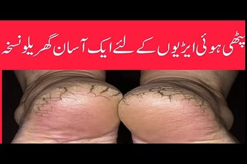 Phati Airyon K Liye Totkay - Cracked Heel Treatment