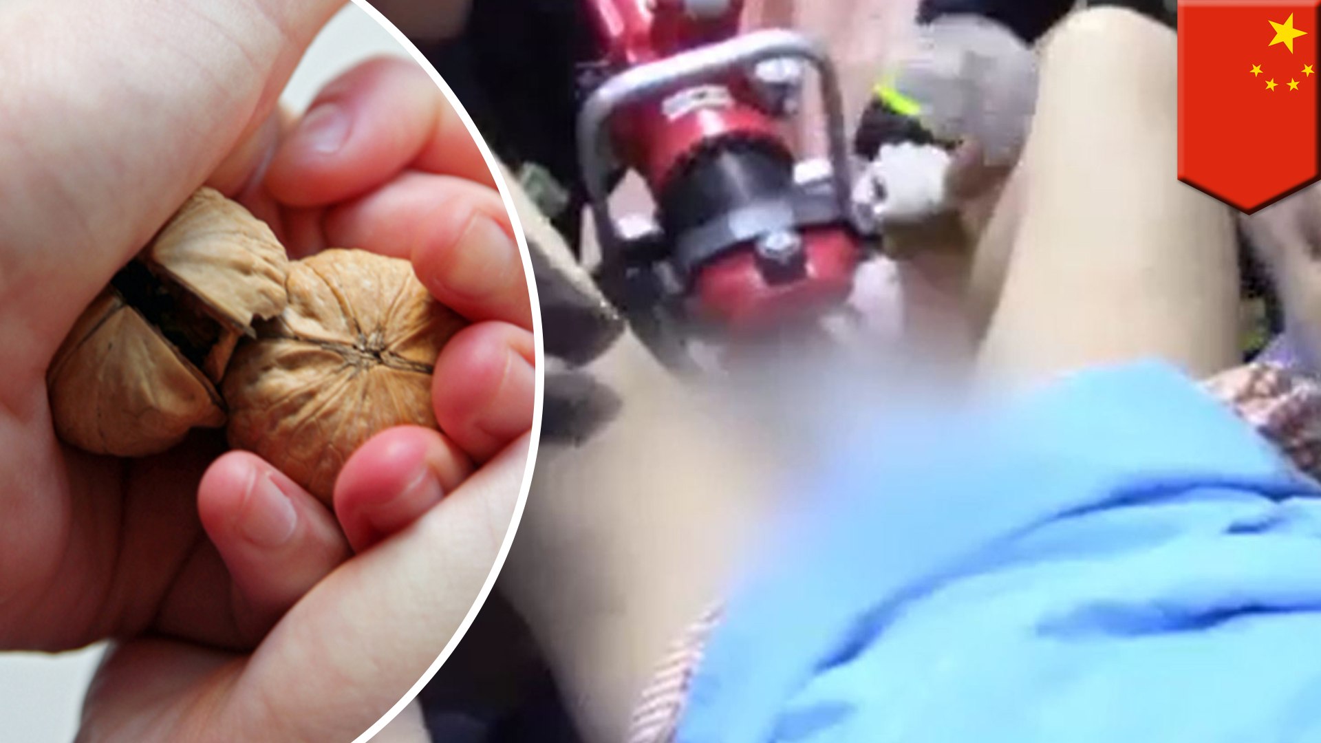 Man S Balls Trapped In Magnets Painful Accident During Magnet Therapy In China Tomonews Video Dailymotion