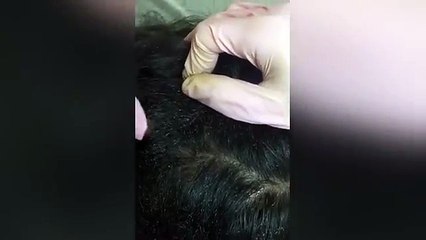 Cette petite fille a le crâne recouvert de poux !