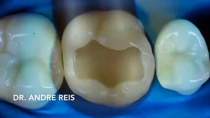 Ce dentiste est un vrai artiste... Reconstruction de dent incroyable