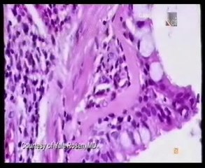 Muerte por asma: Autopsia forense