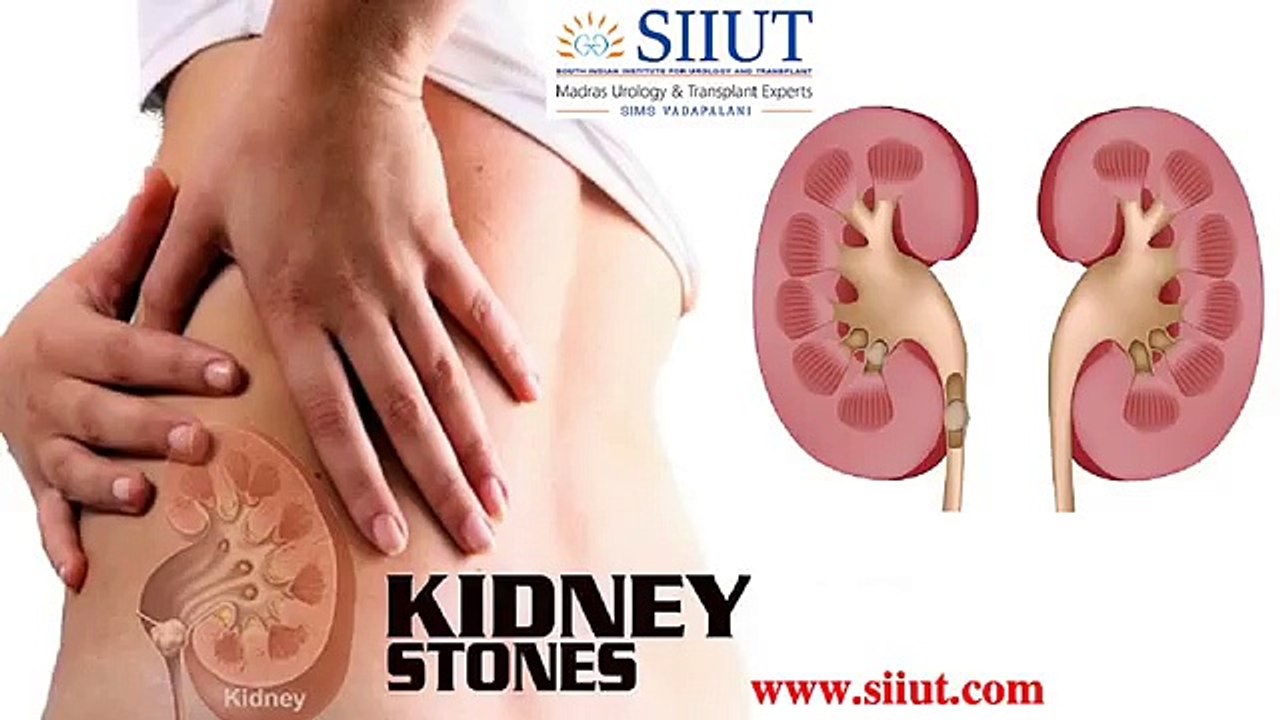 Kidney Stone Specialist in Chennai - Best Urologist In India