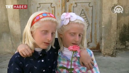 Suriyeli albino hastası ikizler ailelerinin neşe kaynağı