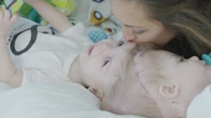 Rare surgery to separate conjoined twins
