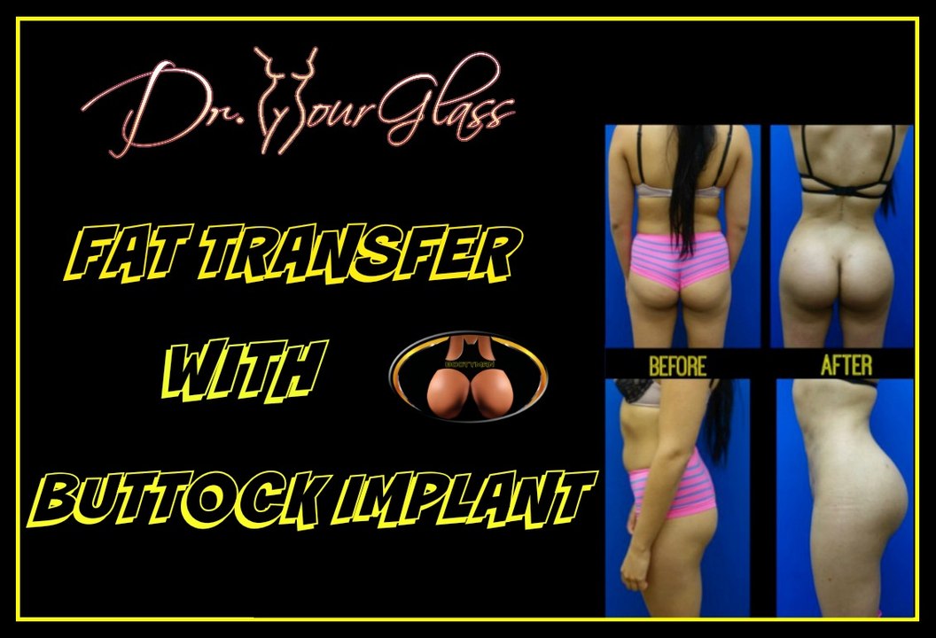 Butt implants surgery