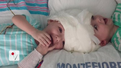 Surgeons Successfully Separate 13-Month-Old Conjoined Twins