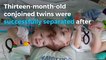 Conjoined twins successfully separated in N.Y.