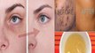 How To Remove Acne Scars, Dark Spots, And Dark Circles Naturally!