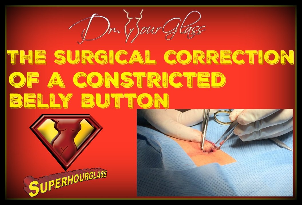 Tummy tuck constricted belly button