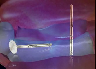 Bone Expander Kit