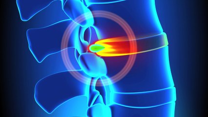 Ameliyatsız Ağrı Tedavisi Nasıl Yapılır? - Op.Dr.Orkun KOBAN