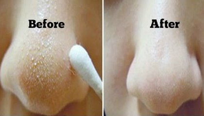 How to Get Rid of Blackheads & Whiteheads At Home in 7 Days