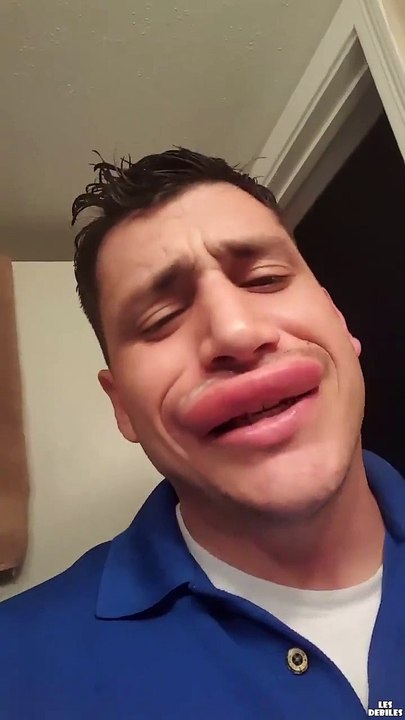 Il est complètement défiguré suite à deux piqûres de guêpes sur la lèvre supérieure