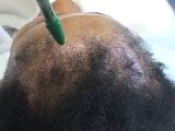 AFRICAN-AMERICAN FEMALE HAIR TRANSPLANT SITES DALLAS TEXAS