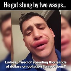 Así reaccionó un hombre al ser picado por dos avispas en los labios