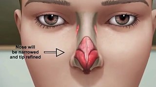 Amazing Nose Oprate Must Watch Like & Share