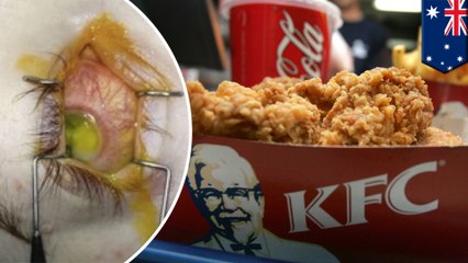 กินเคเอฟซี และ โค้ก นานแปดปี เด็กวัยรุ่นตาเกือบบอด