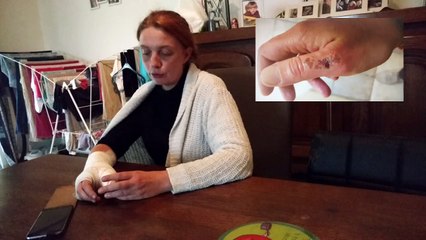 Mordue par une araignée, Séverine risquait l'amputation