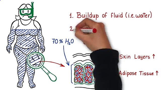 Cellulite Treatment (Best cellulite treatment EVER)