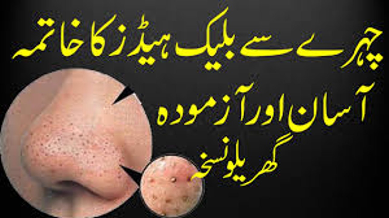 Blackhead Khatam Karne Ka Asan Gharelu Ilaj  How to Remove Blackheads From Nose & Face