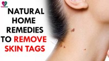 Natural Home Remedies to Remove Skin Tags - Health Sutra