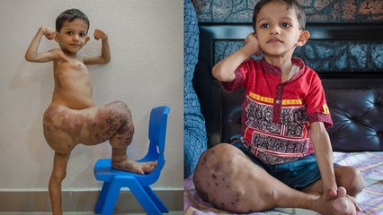 3-Year-Old Boy Struggles to Walk After a Rare Condition