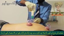 Hijama Cupping Therapy (حجامہ کیا ہے؟)..Urdu