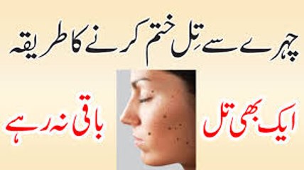 Blackhead Khatam Karne Ka Asan Gharelu Ilaj  How to Remove Blackheads From Nose & Face