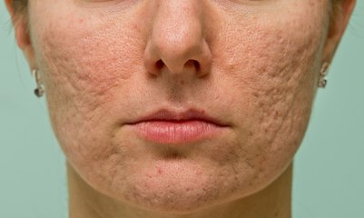 How to get rid of acne scars