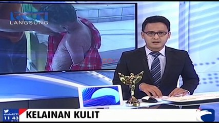 Penyakit Ictiosis Lamelaris Menimpa Bocah di Palangkaraya Kalimantan Tengah