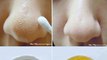 Get Rid Of Blackheads In No Time With These Easy Tips