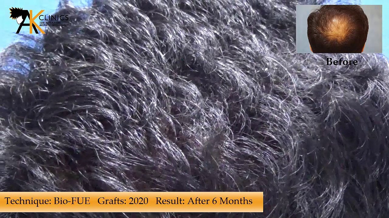 Hair Transplant result with Bio-FUE Technique of 2020 Graft